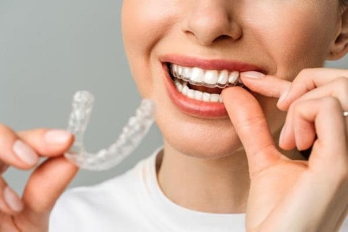 ¿Es Invisalign una opción válida para mí?