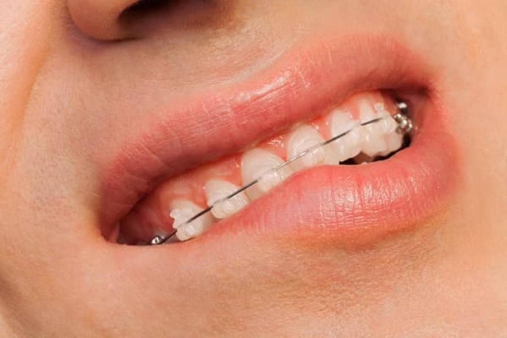 Tipos de brackets, ¿cuáles son los más adecuados para usted?