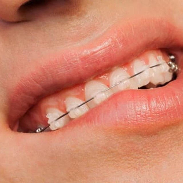 Tipos de brackets, ¿cuáles son los más adecuados? 